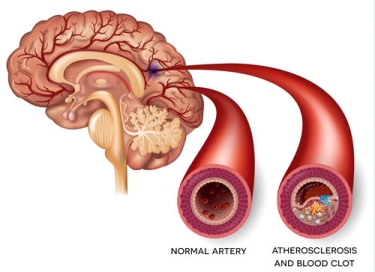 stroke image